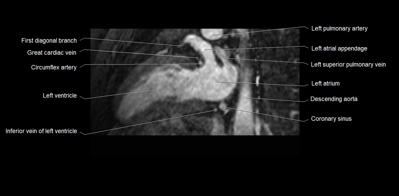 MRI heart and coronary arteries two chamber(sagittal)  anatomy image 29.webp